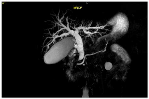 What Is A Mri With Mrcp At Rebecca Skinner Blog