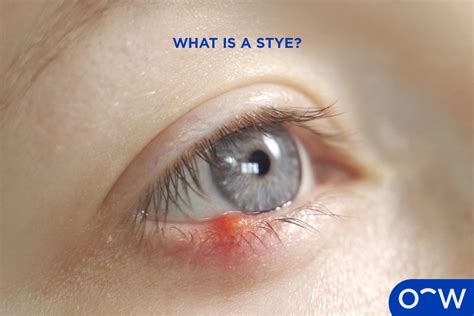 What Is A Stye Causes Treatment And Other Faqs Goodrx