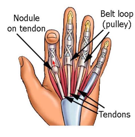 What Is A Trigger Finger Orthopaedic Associates