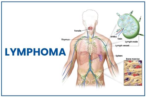 What Is Lymphoma Baysection