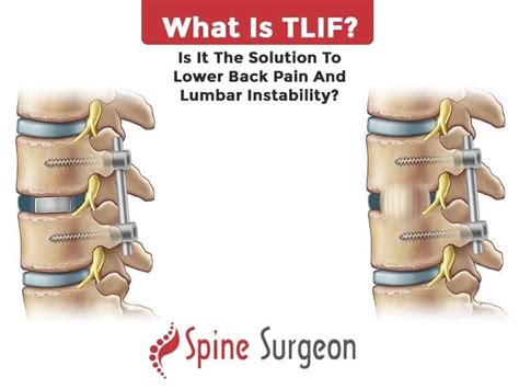 What Is Tlif Is It The Solution To Lower Back Pain And Lumbar