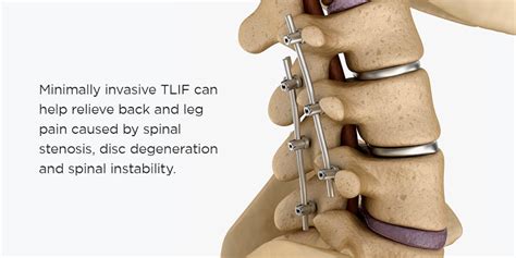 What Is Tlif Surgery New York Spine Institute