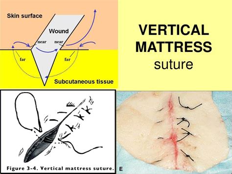 What Is Vertical Mattress Suture At Francisco Worthington Blog
