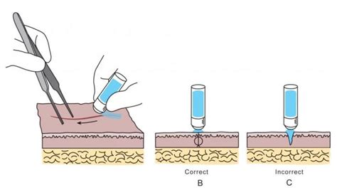 Wound Glue A Revolution In Wound Care How To Guide